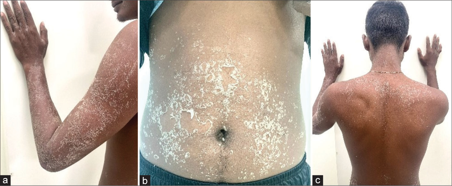 Exanthematous eruptions over different areas of the body, (a): Lesions over the arms, (b): Lesions over the abdominal region, (c): Lesions over back.