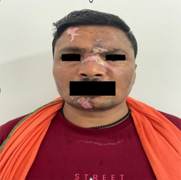 Wounds in different stages of healing at week 1. (Multiple well defined erosive areas of size varying 0.5 × 0.5 cm to 4 × 3 cm,presented over forehead,above nasal ridge and chin).