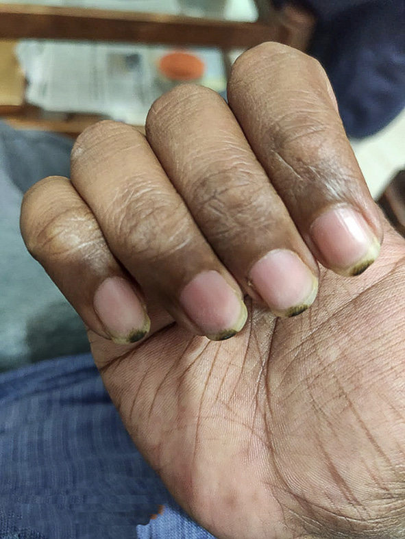 Nail hyperpigmentation caused in a patient due to fluoxetine use.