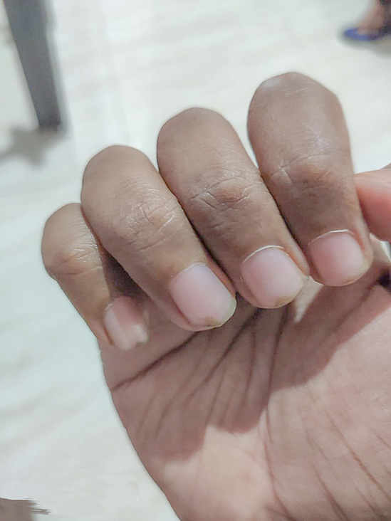 Nail pigmentation reduced after stopping the fluoxetine use.